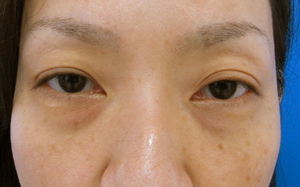 目の下のたるみ、目のくまでお悩みの方、切らずに完璧に解決します。TCB-R法　手術直後　症例写真